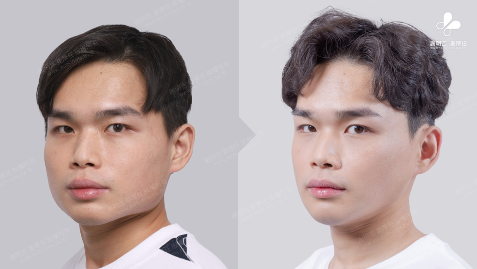 Mr. Lee 术前术后对比 13