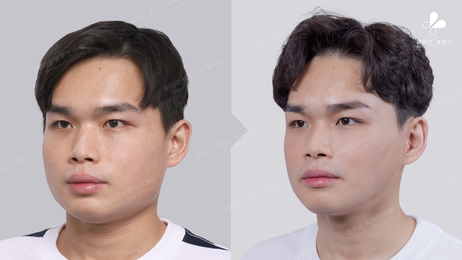 Mr. Lee 术前术后对比 14