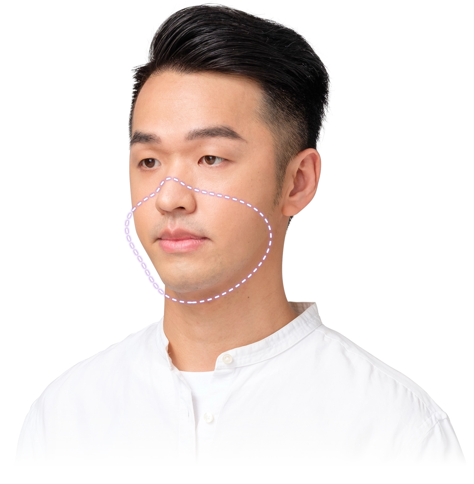 正颌手术 术后成果